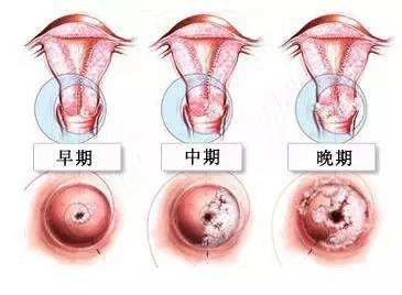 宫颈糜烂的发病原因有哪些